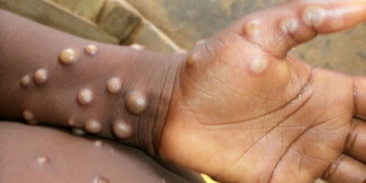 Osun Confirms Two Cases Of Monkeypox