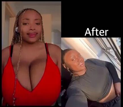 Lady Excitedly Shares Amazing Chest Reduction Surgery Results