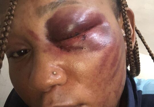 15 Years In Abusive Relationship With A Beast Has Cost Me My Left Eye – Lady (Photos)