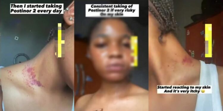 Lady Shares Shocking Skin Effects After Taking Postinor-2 Daily