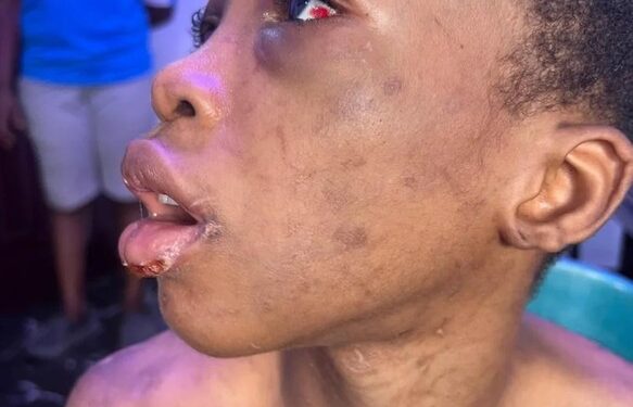 Girl Badly Beaten, Burnt And Starved By Her Guardian Rescued In Lagos (Photos)