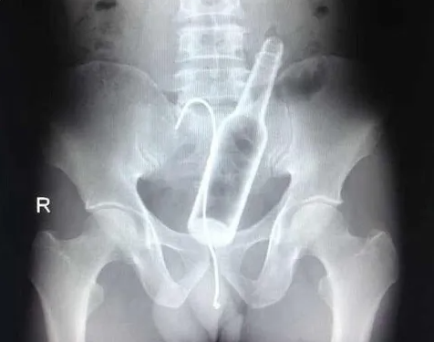 4,000 Americans are hospitalized each year with a ‘foreign object’ stuck up their bum, study finds