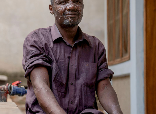NCDC reports higher Mpox infection among males in Nigeria