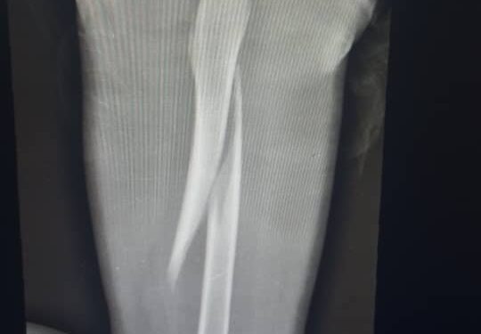 Woman accused of breaking 3-year-old stepson’s leg with pestle in Enugu State