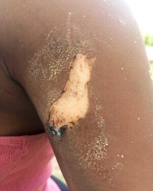 Osun tailor allegedly burns 17-year-old customer with hot iron over clothing dispute