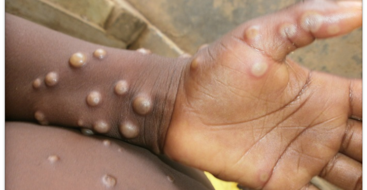 Ondo government confirms 12 monkeypox cases