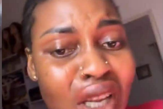 Lady cries out after attraction kayamata lip gloss gives her swollen lips