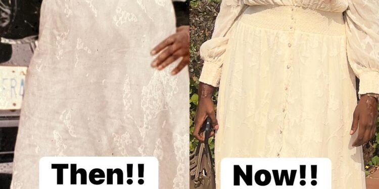 I almost lost my smile while growing up – Nigerian burn survivor writes as she shares before and after photos