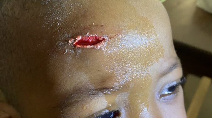 Mother shows scar on son inflicted by classmate at school