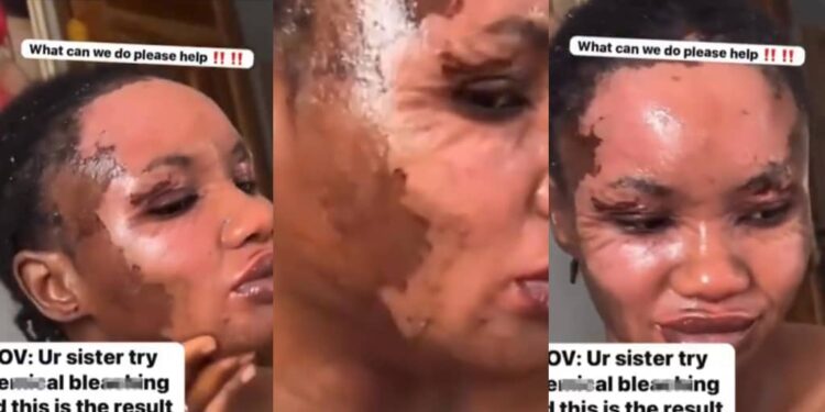 Lady seek help after a chemical peel to bleach her skin goes wrong