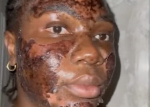 Lady cries out after severe burn from vendor’s ‘free’ acne procedure