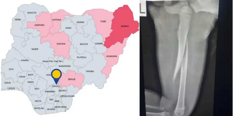 Stepmother breaks 3-year-old stepson’s bone with pestle in Enugu