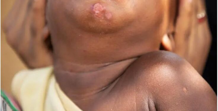 Nigerian Woman Disfigures Her Children’s Faces With Bleaching Cream