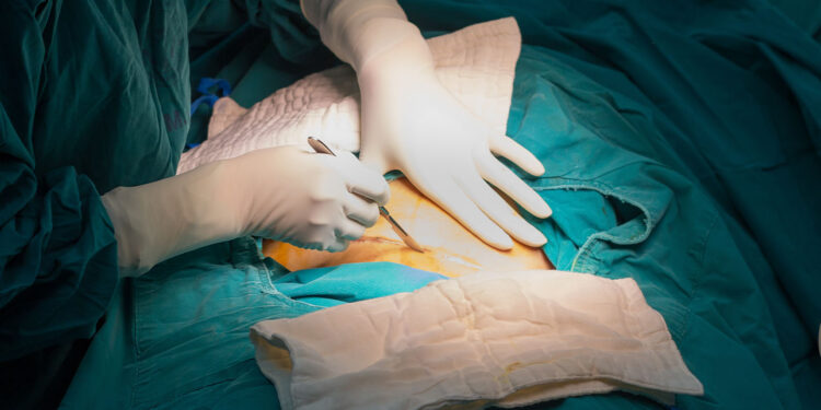FG announces free caesarean sections for women