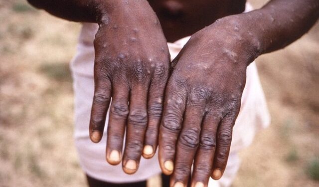 Nigeria records 39 Mpox cases